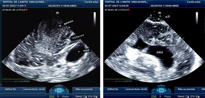 左圖顯示術(shù)中超聲見囊實性病變，大小約為4x4x3cm，病灶周圍腦組織水腫明顯；右圖為病灶切除后，術(shù)中超聲示術(shù)腔無病變殘留